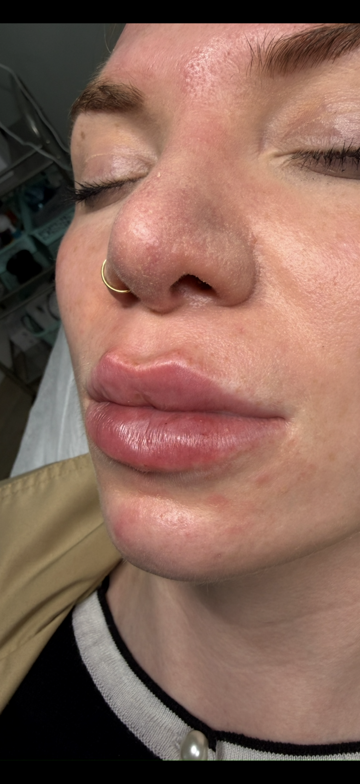 After — Lip enhancement before and after