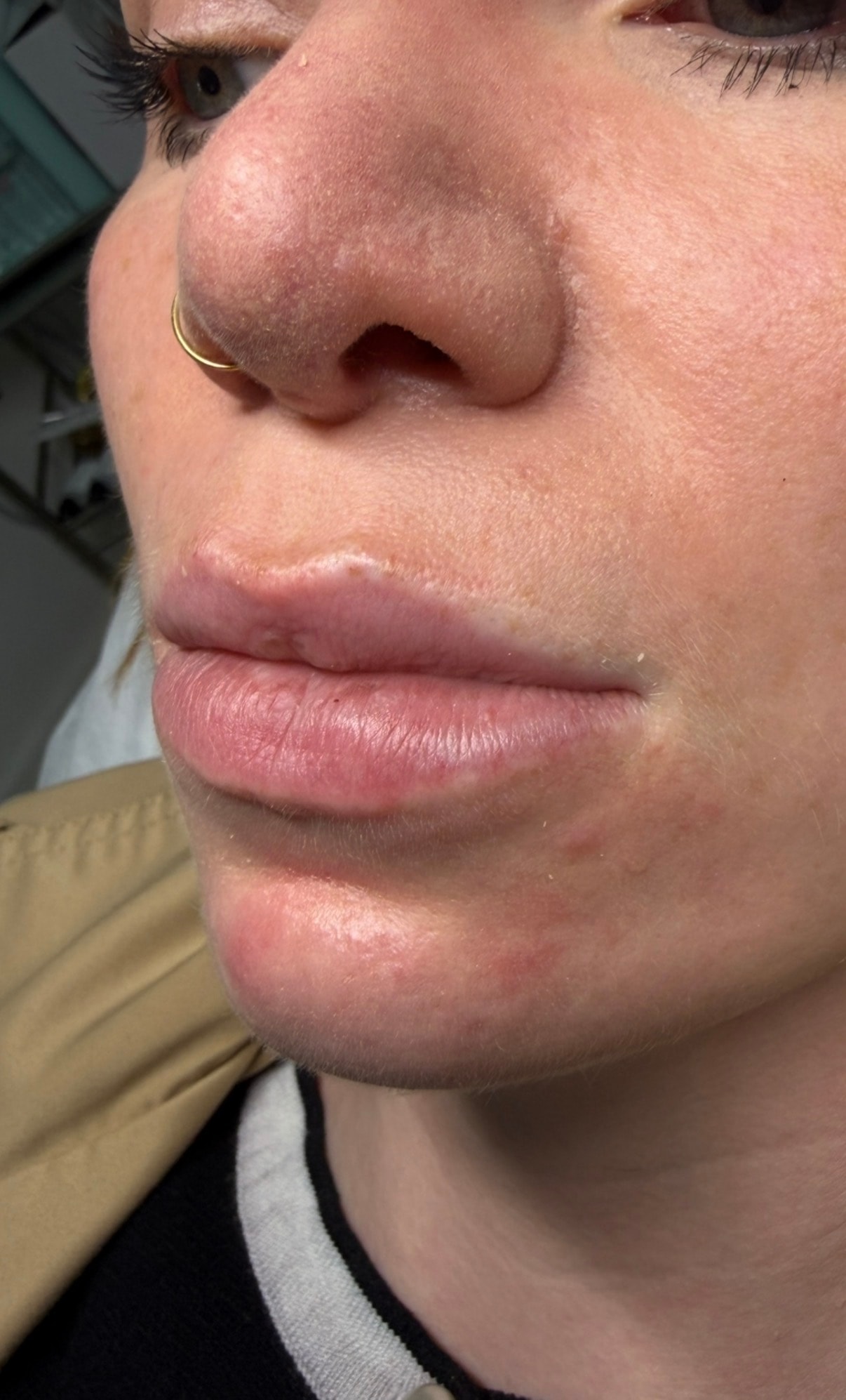 Before — Lip enhancement before and after