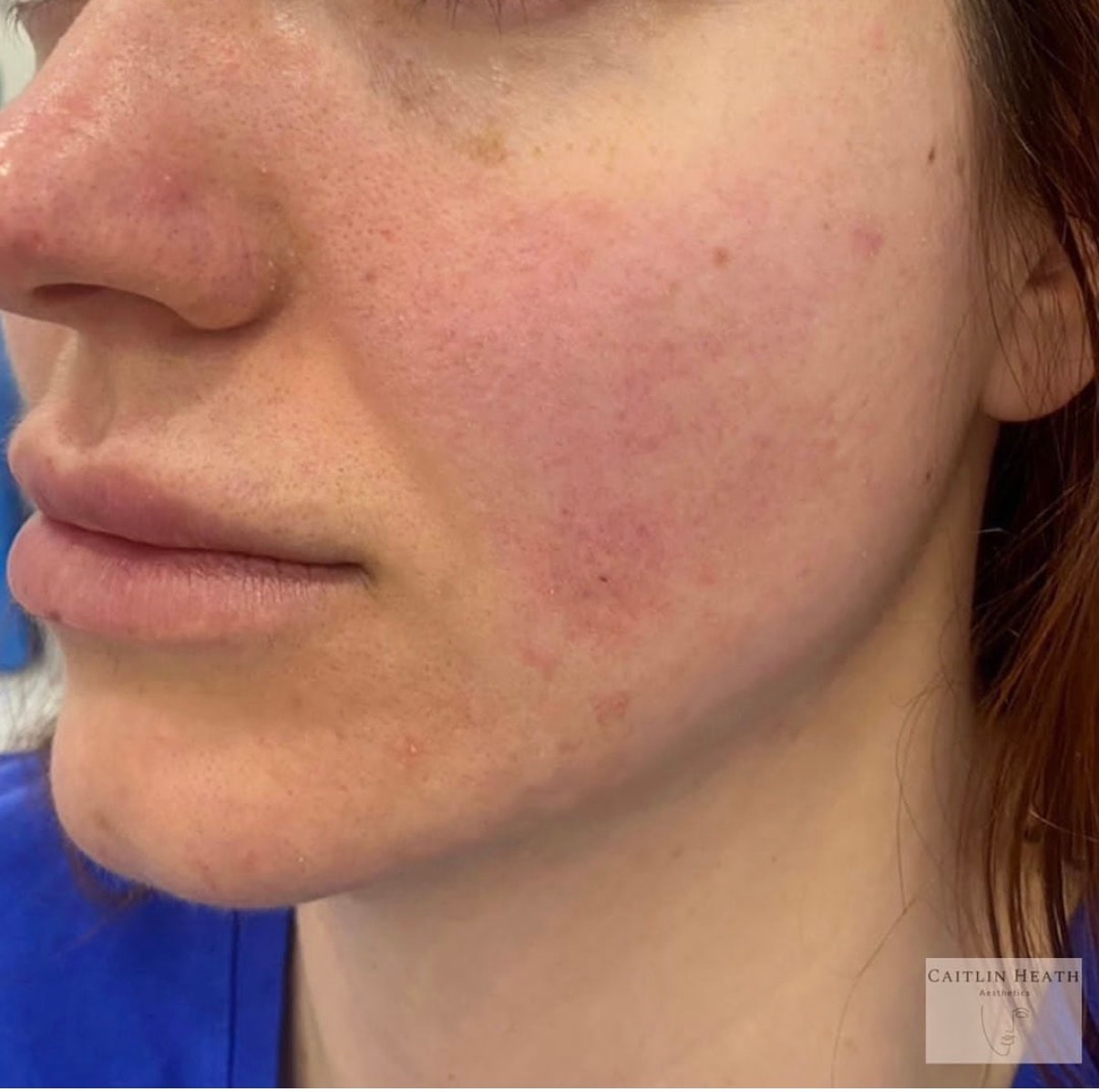 After — Dermal filler before and after