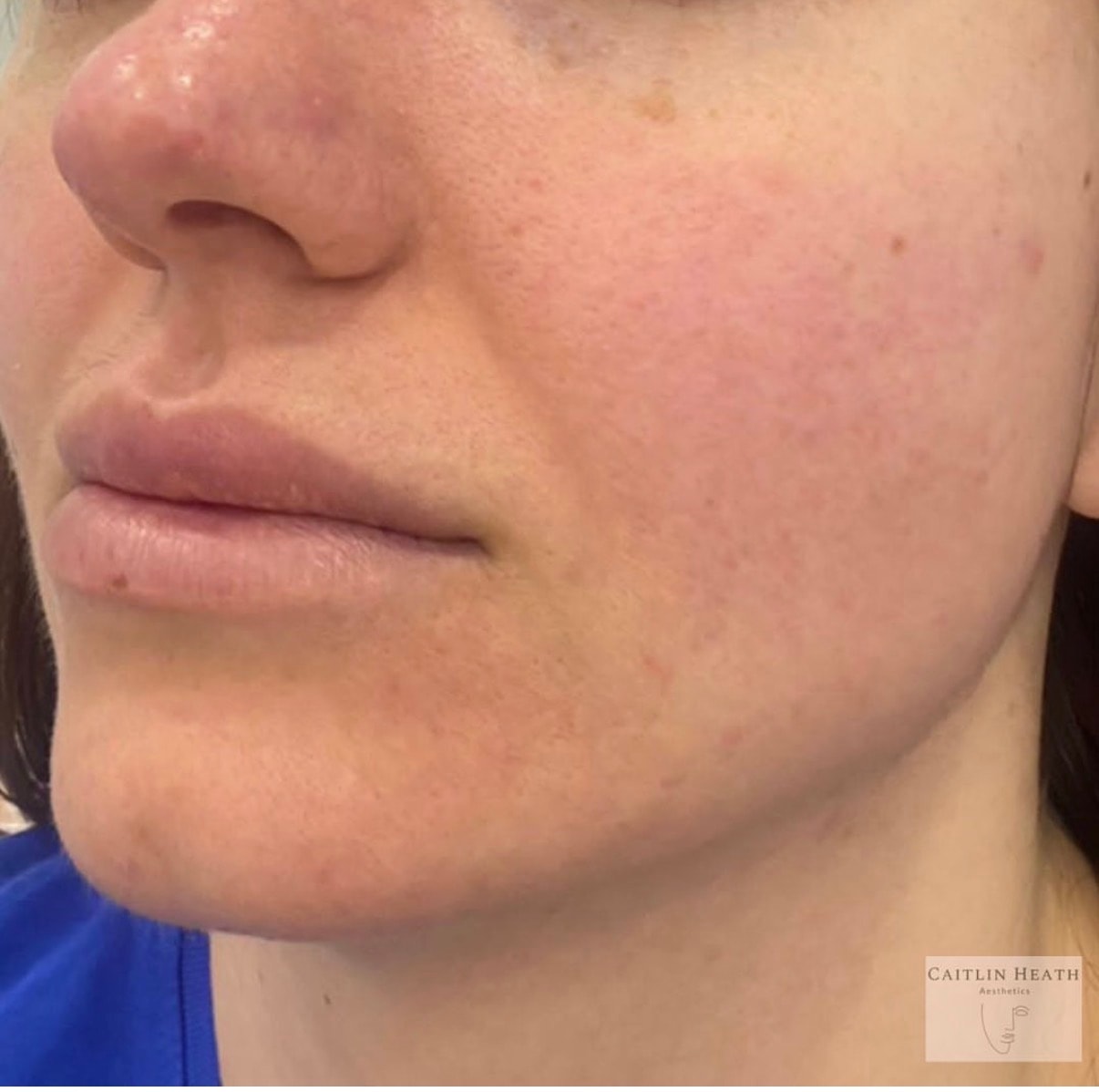 Before — Dermal filler before and after