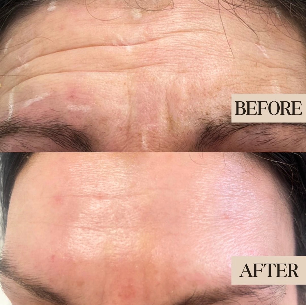 After — Anti-wrinkle treatment before and after