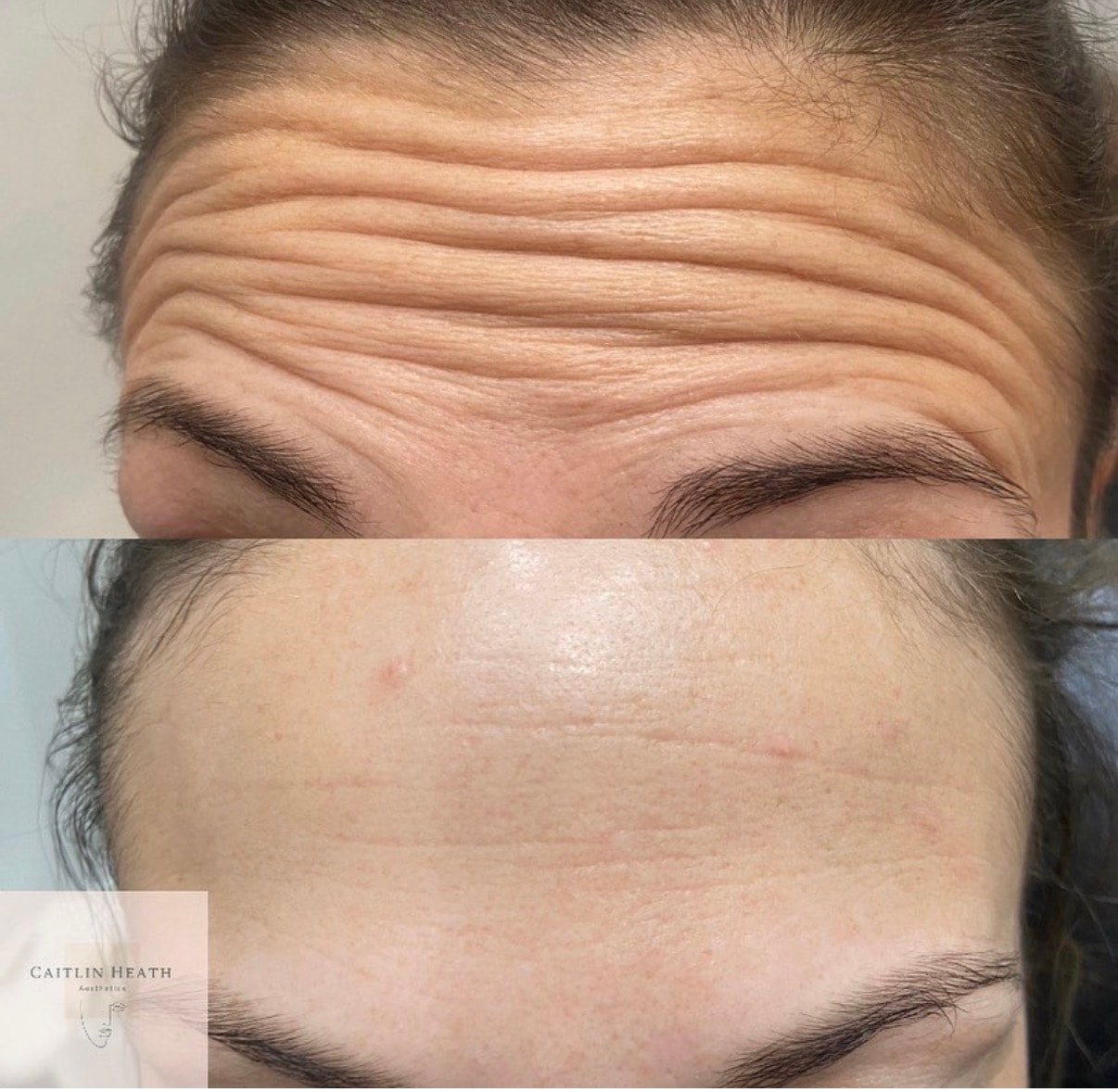 Before — Anti-wrinkle treatment before and after