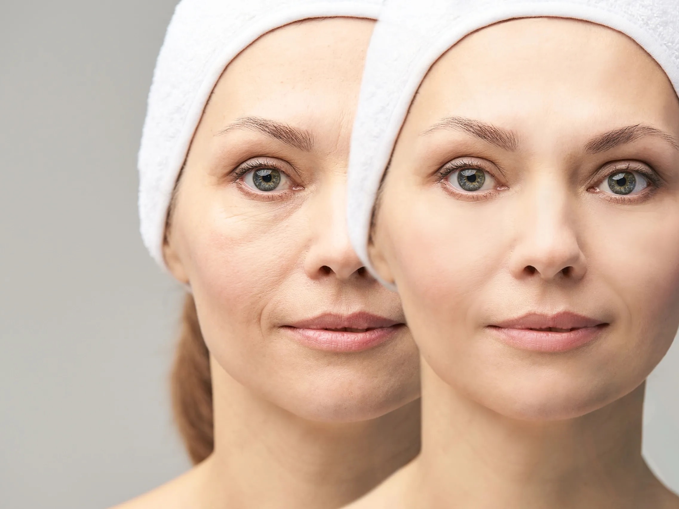 Dermal Fillers